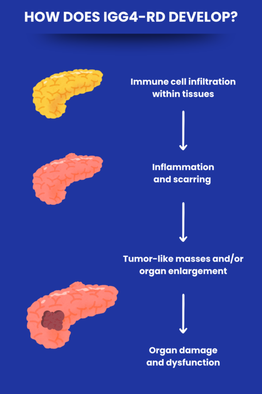 How IgG4-RD develops