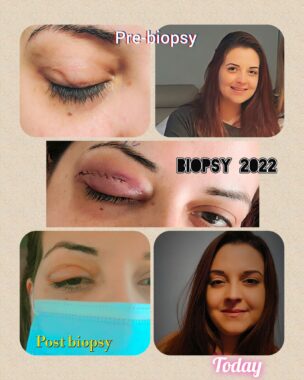 A collage of five photos all focus on a woman's eye, which is shown pre-biopsy, immediately after an eyelid biopsy, and during her recovery.