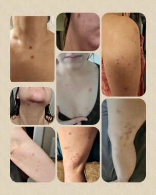 A collage of photos showcase lesions and eruptions on a woman's body.